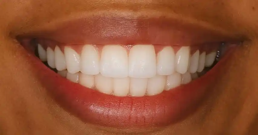 After teeth alignment case 2