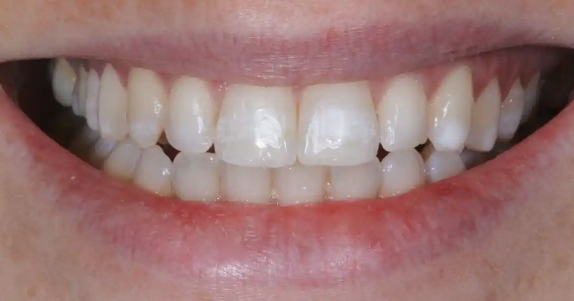 After teeth alignment case 4