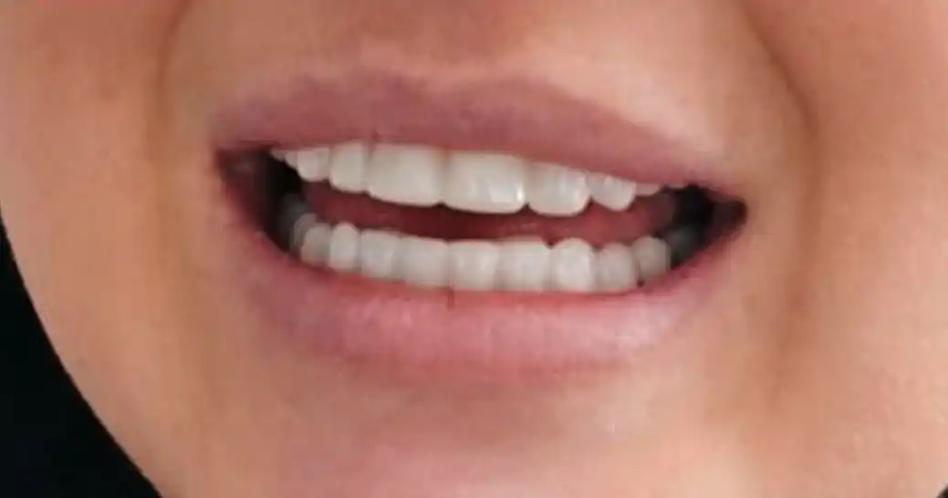 After teeth alignment case 5