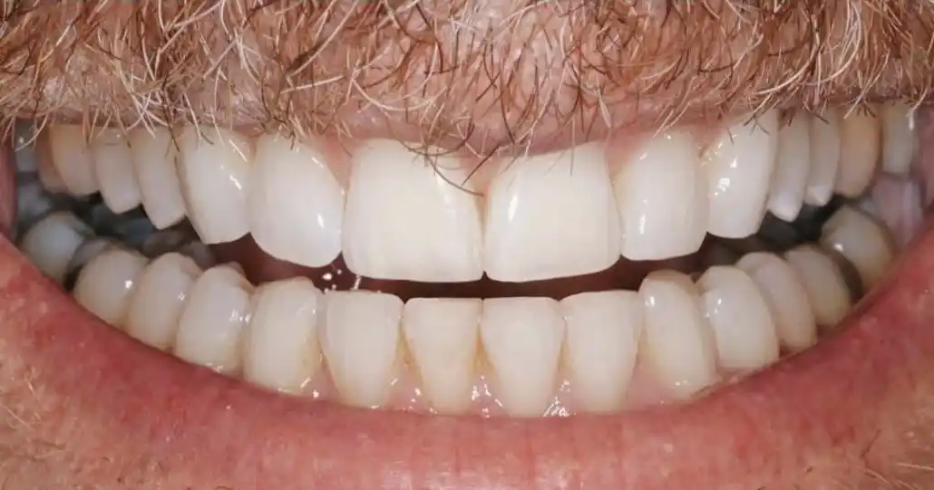 After teeth alignment case 6
