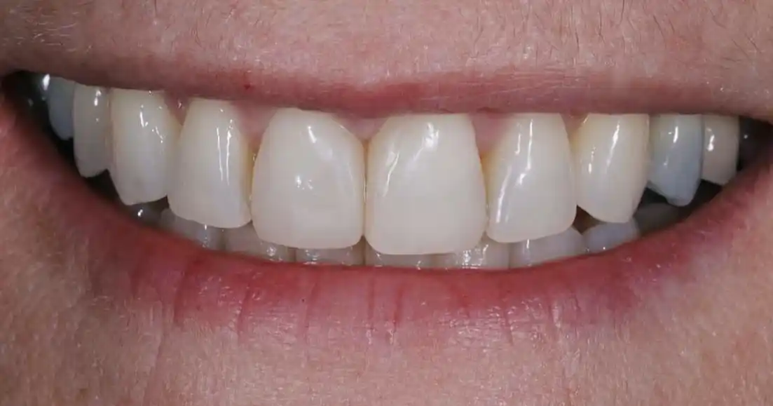 After teeth alignment case 7