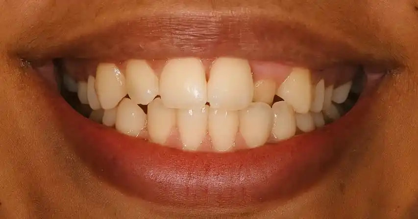 Before teeth alignment case 2