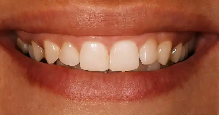 Before teeth alignment case 3