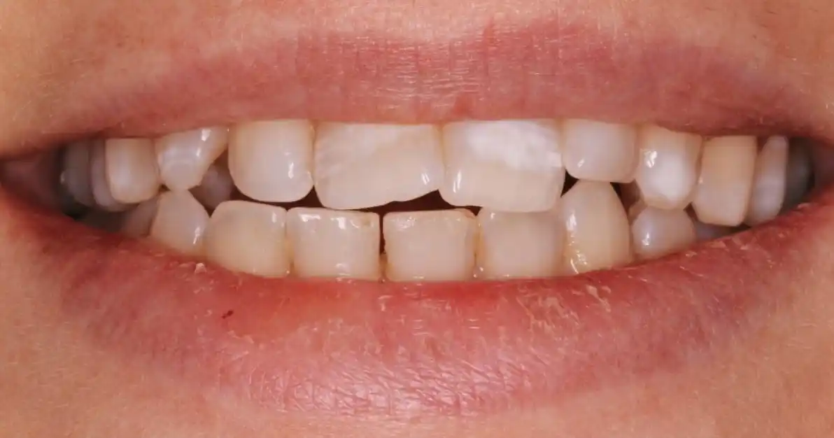 Before teeth alignment case 4