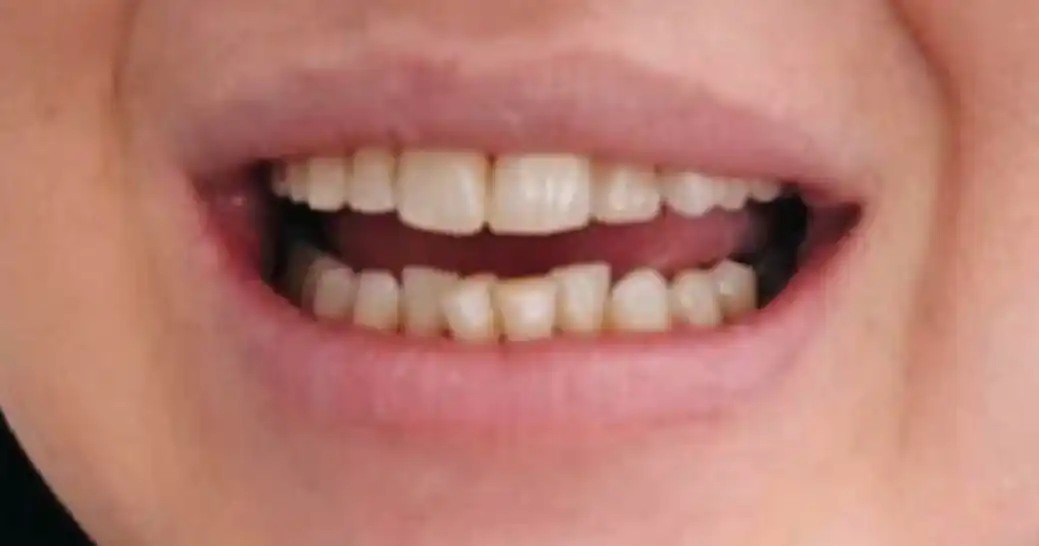 Before teeth alignment case 5