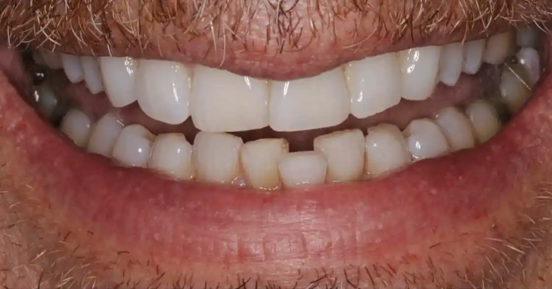 Before teeth alignment case 6