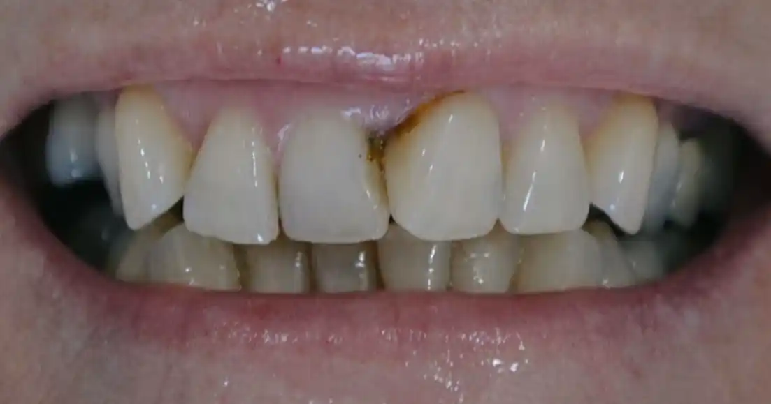 Before teeth alignment case 7